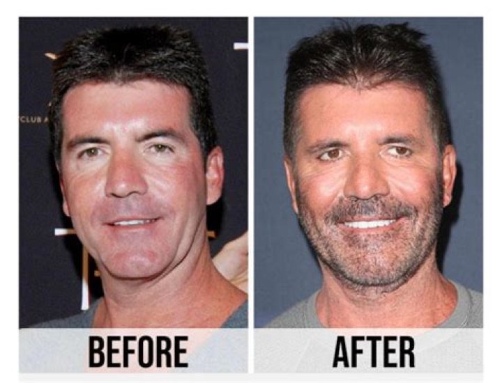 Has Simon Cowell Had A Stroke? His Illness And Health Update |